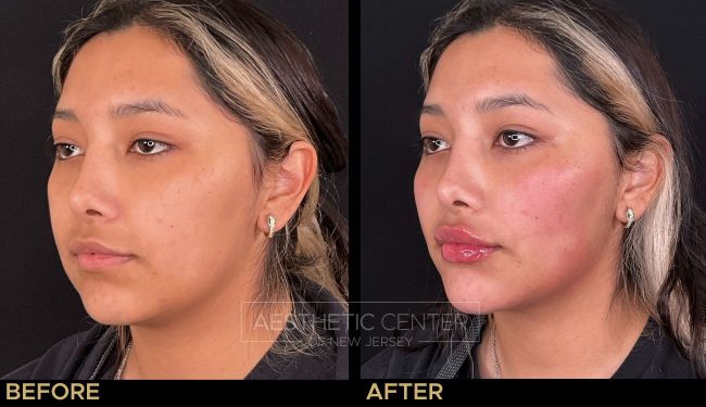 Facial balancing with filler and lip filler on a young female patient.