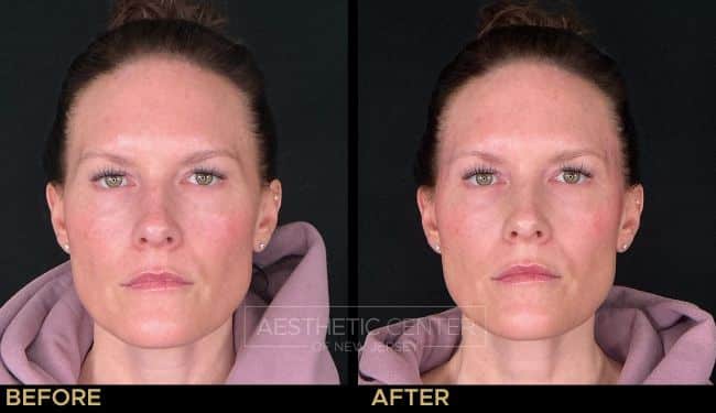 Before and after of temple filler to reduce hollowing and balance the face.