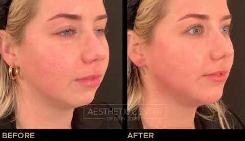 Jawline Contouring and Chin Filler - Before & After