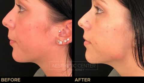 Jawline Contouring with Voluma Filler - Before & After