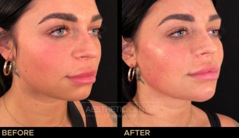 Jawline Contouring and Chin Filler - Before & After