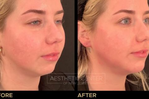 Jawline Contouring and Chin Filler - Before & After