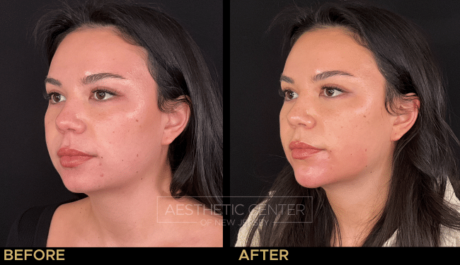 Chin filler to enhance projection and overall balance.