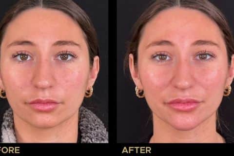 Chin Filler to enhance overall balance and shape of the face.