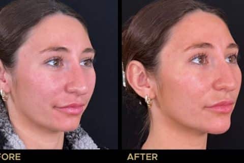 Chin Filler to enhance overall balance and shape of the face.