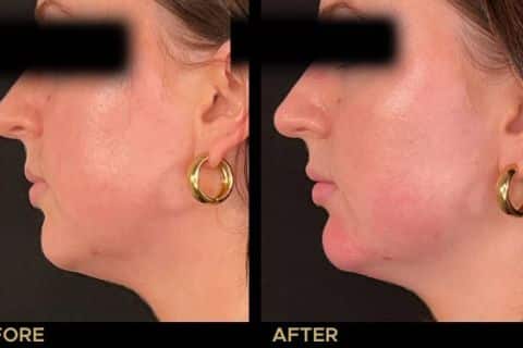 Chin Filler to enhance overall balance and shape of the face.