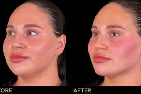 Cheek and Jawline Filler to enhance overall balance and shape of the face.
