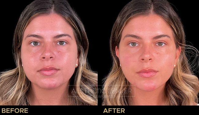 Facial balancing including Chin Filler to enhance overall balance and shape of the face.