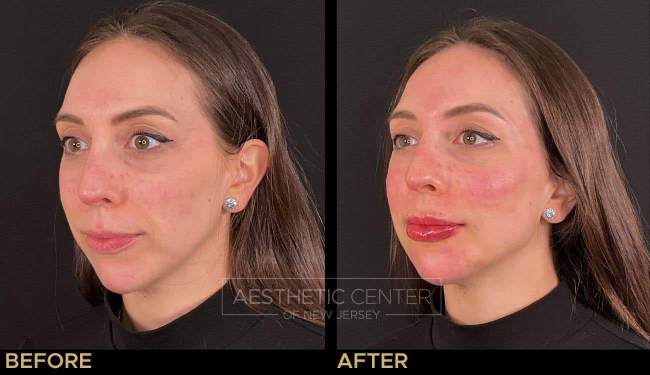 Facial balancing with chin and cheek filler.