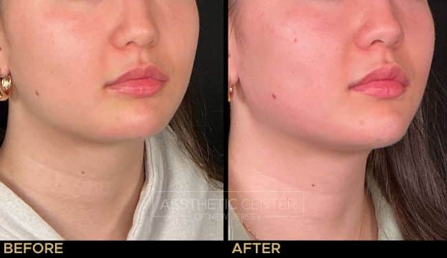 Jawline, chin, and lip filler results on a female.