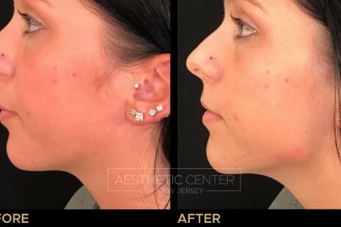 Jawline Contouring with Voluma Filler - Before & After