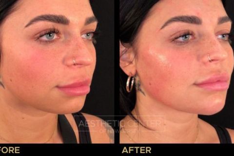 Jawline Contouring and Chin Filler - Before & After