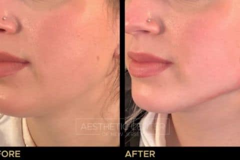 Jawline Contouring with Radiesse Filler - Before & After