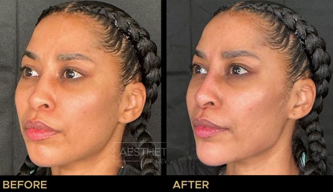 Female Jawline filler before and after.