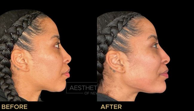 Female Jawline filler before and after side view.