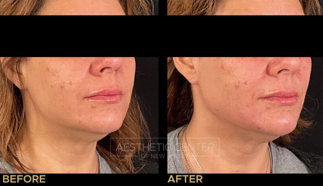 Female Jawline filler to add natural definition and contour before and after.