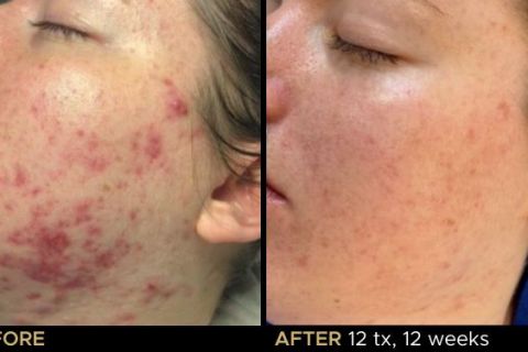 LED Phototherapy B&A - 1