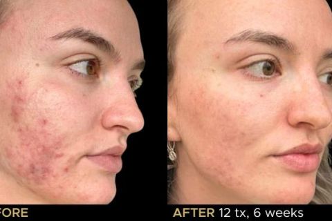 LED Phototherapy B&A - 2
