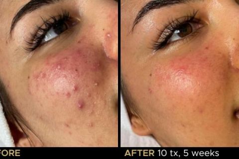 LED Phototherapy B&A - 3