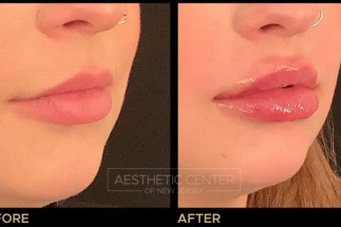 Before and after of lip filler treatment on young female.