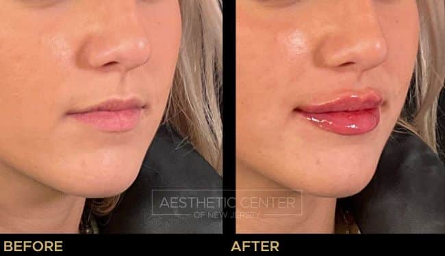 Before and after of lip filler treatment on young female.