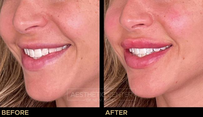 Before and after of lip filler treatment on  female.