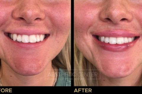 Before and after of lip filler treatment on young female to correct gummy smile.