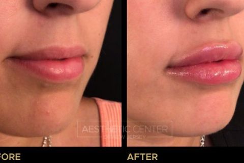 Before and after of lip filler treatment on young female.