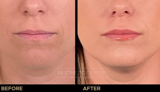 Lip filler before and after on thin lips with a natural result.