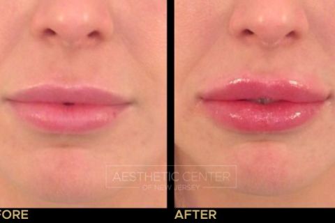 Before and after of lip filler treatment on young female.