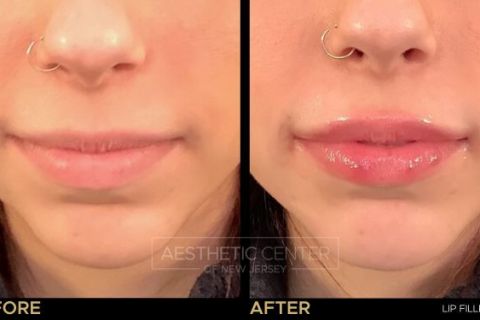 Before and after of lip filler treatment on young female.