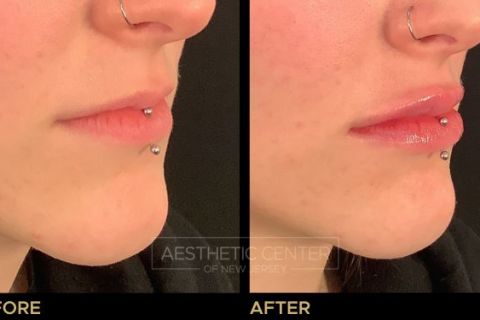 Before and after of lip filler treatment on young female.