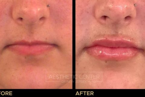 Before and after of lip filler treatment on young female.