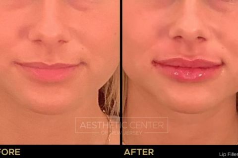 Before and after result of lip filler treatment on young female.