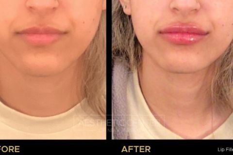 Before and after of lip filler treatment on young female.