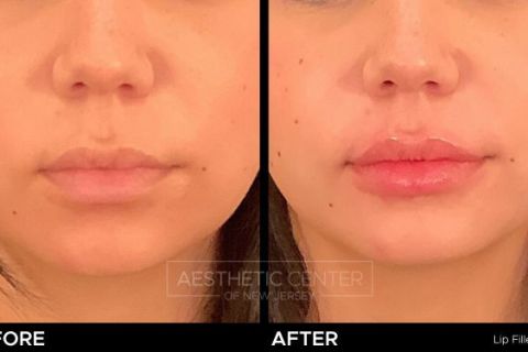 Before and after of lip filler injections on young female.