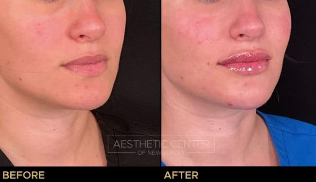 Before and after of lip filler treatment on young female.