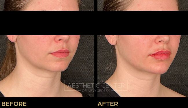 Before and after of subtle lip and chin  filler treatment on young female.