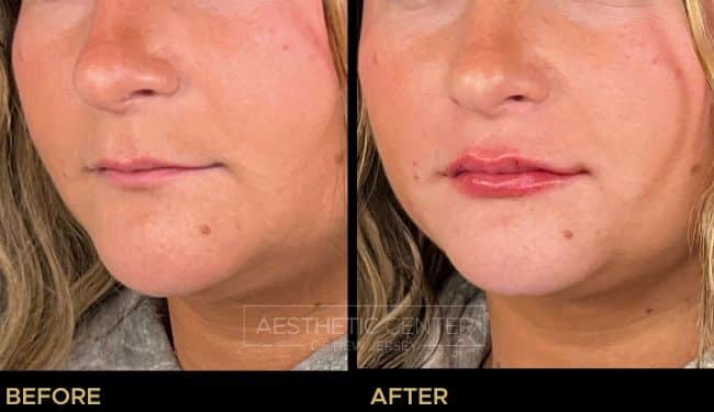 Before and after of lip filler treatment on young female. Natural result on thin lips.