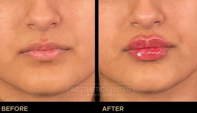 Before and after of lip filler treatment on young female looking for poutier lips with more height. 