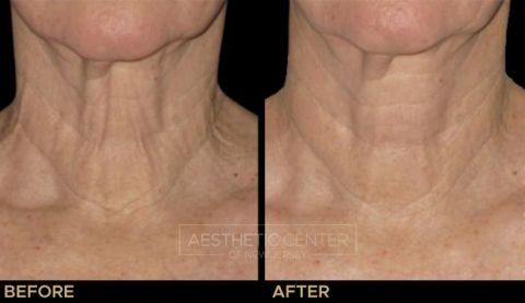 Before & after result of Ultherapy skin tightening for sagging and lines on woman's neck.