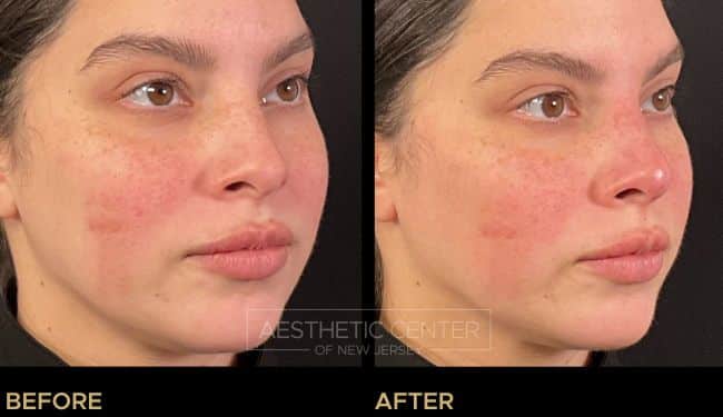 Non-surgical rhinoplasty nasal tip lift with PDO threads to improve the contour and shape of the nose.