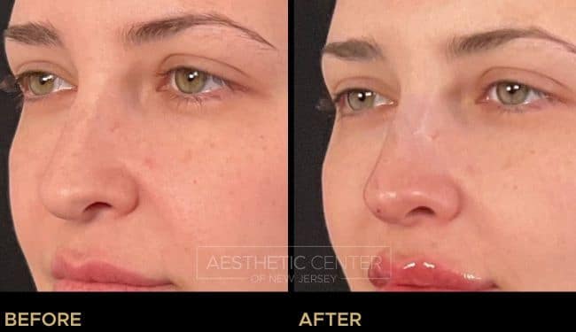 Non-surgical rhinoplasty nasal tip lift with PDO threads to correct a mild drooping tip.