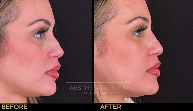 Website B&A Gallery - SIERRA SHAPPY - NOSE FILLER - NICOLE