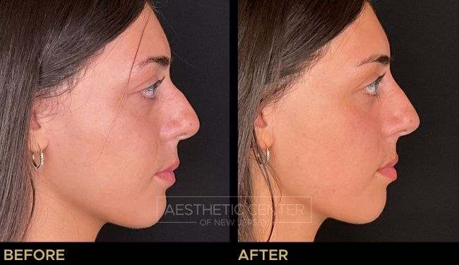 Non-surgical rhinoplasty with dermal filler to correct a visible dorsal hump on a female patient.