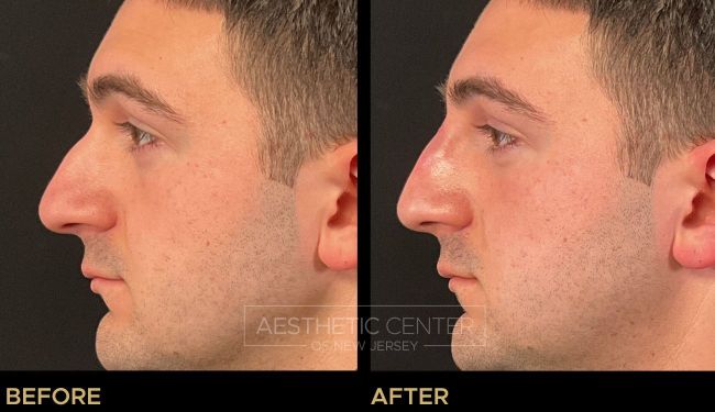 Non-surgical rhinoplasty with dermal filler to correct a visible dorsal hump  on a male patient.