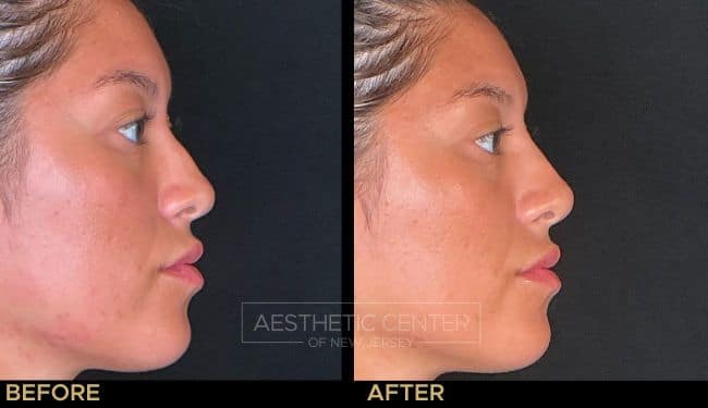 Non-surgical rhinoplasty with dermal filler to correct a mild dorsal hump on a female patient.