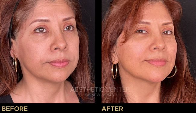 Full face PDO thread lift on a woman. 