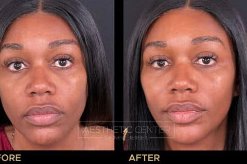 Cheek PDO thread lift on a woman. 