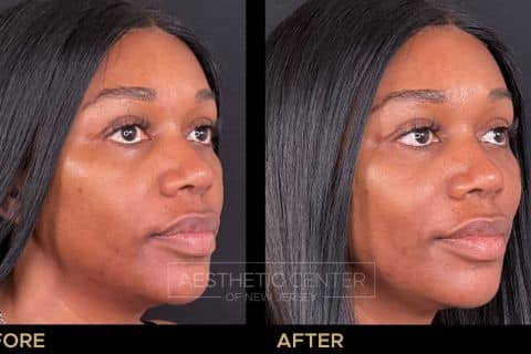 Cheek PDO thread lift on a woman. 